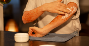 skin & soft tissue infection treatment in indore
