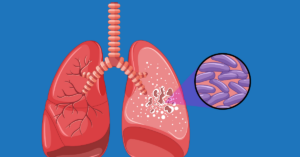 TB specialist in indore