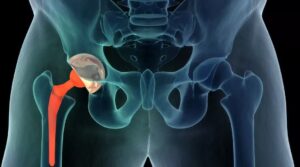 Prosthetic Joint Infection Specialist in Indore