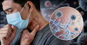 fungal infection treatment