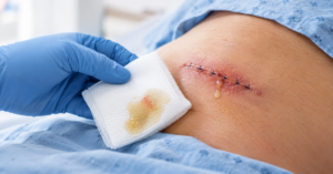 post-surgical infections treatment