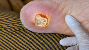 Diabetic Foot Infection Specialist in Indore